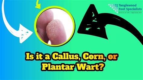 How to Tell the Difference Between a Callus, a Corn, and a Plantar Wart - YouTube