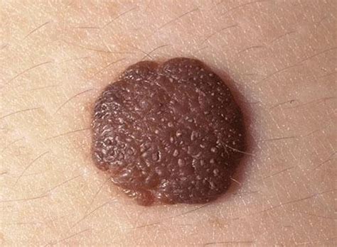 Moles - Skin Disorders - MSD Manual Consumer Version