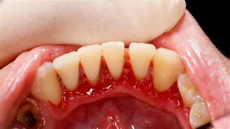 Gum Disease: A Cancer Risk Factor - Scottsdale Cosmetic Dentistry ...