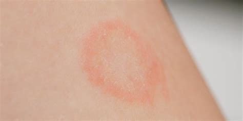 How to Cure Fungal Infections on the Skin Naturally | HealthNews