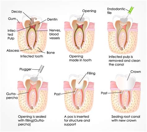 Root Canal Treatment | T32 Dental Group