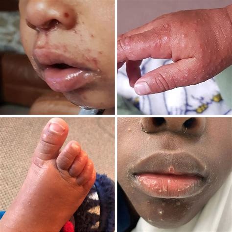 Hand Foot And Mouth Disease Adults Face