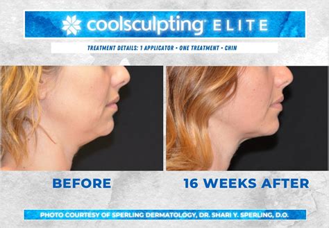 Submental Fat CoolSculpting Before & After Patient 26 | Sperling Dermatology