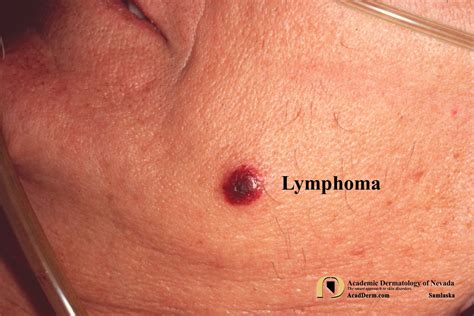 Cutaneous Lymphoma: Please Contribute To The Leukemia & Lymphoma ...