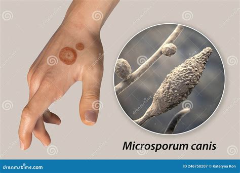 Fungal Infection on a Man S Hand. Tinea Manuum and Close-up View of ...