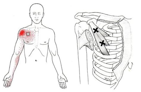 Chest / Rib Pain - Massage Therapy Connections