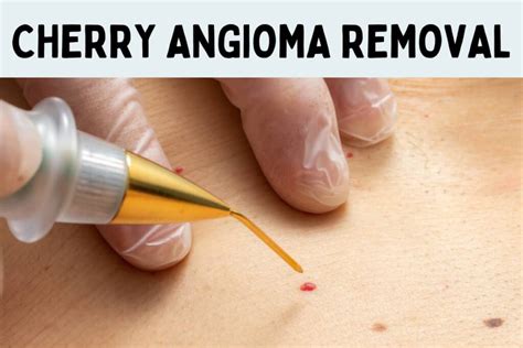 Removal of Cherry Angiomas: How to Get Rid of Red Moles?