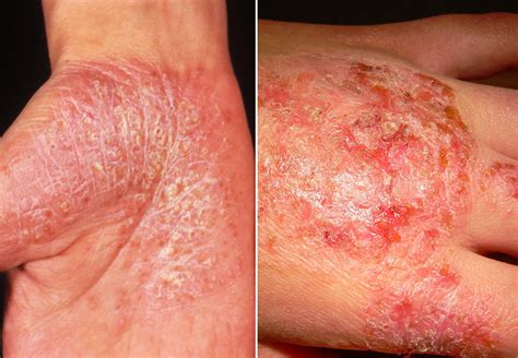 What Is Eczema Dermatitis Is The Inflammation Of Skin | My XXX Hot Girl