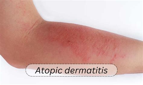 Management of atopic dermatitis with topical therapies in adults ...