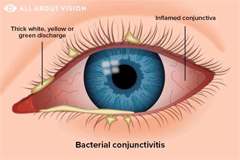 146 Images Viral Conjunctivitis For FREE - MyWeb