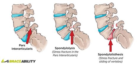 Have A Pars Defect at L4-L5? It Might Be Spondylolisthesis