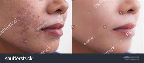 Image Before After Dark Spot Scar Stock Photo 1453206524 | Shutterstock