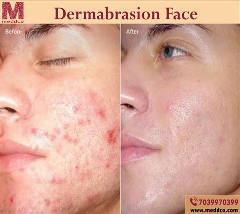 How often should you Dermabrasion your face?