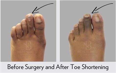 Pin on Hammer toe surgery