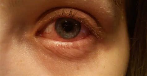 Bacterial Eye Infections: Symptoms, Types, and Treatments