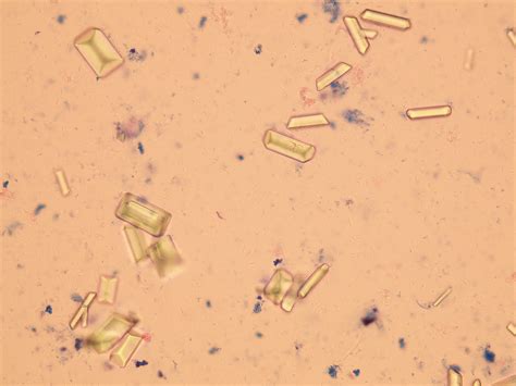 Triple Phosphate Crystals In Human Urine