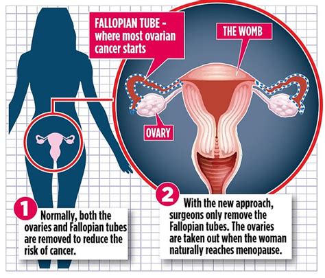 New operation cuts the risk of ovarian cancer... and an early menopause | Daily Mail Online