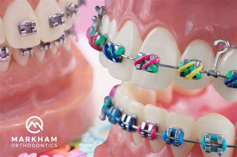 How to Choose the Right Braces Colors - Markham Ortho