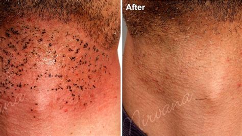 Brazilian Laser Hair Removal Before And After Photos - Hair Style Blog