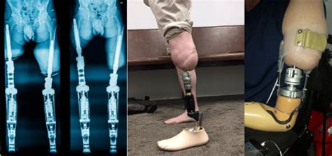 prosthesis (eep), the best orthopedic surgeons in Iran, accommodation