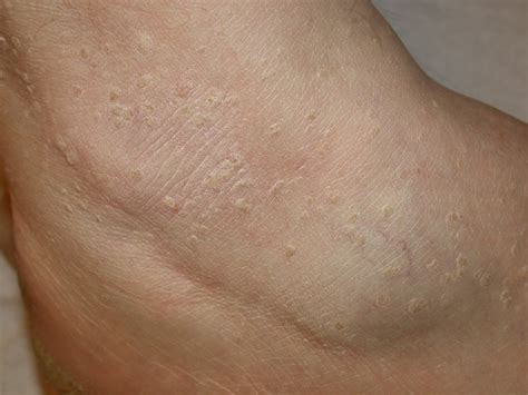 Stucco Keratosis - Pictures, Symptoms, Causes, Diagnosis, Treatment