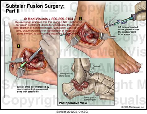 Medivisuals Subtalar Fusion Surgery - Part II Medical Illustration