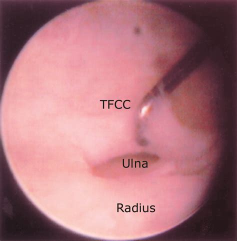 Wrist Arthroscopy - OrthoInfo - AAOS