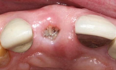 Granulation Tissue Tooth Extraction