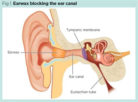 Earwax impaction: why it needs to be treated in primary care | Nursing Times