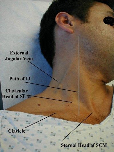 What it Looks Like: Jugular Vein Distention | EMS Basics | Jugular venous pressure, Medical ...