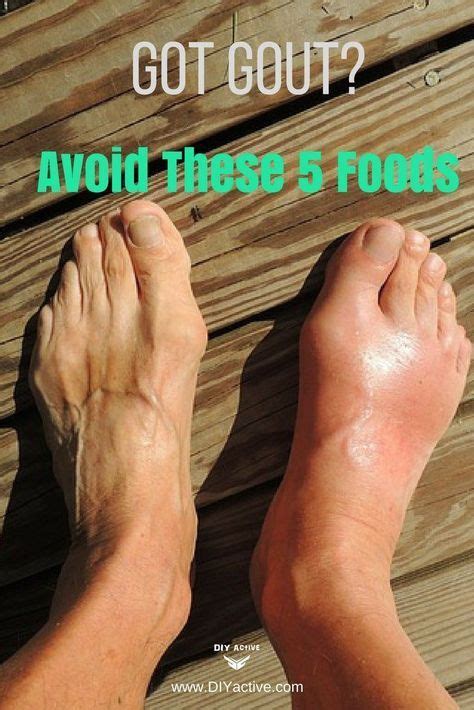 5 foods to avoid if you have gout to reduce symptoms | Home remedies for gout, Gout remedies ...