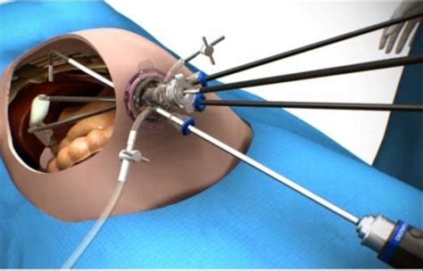 SILS/Scarless Cholecystectomy (single incision laparoscopic ...