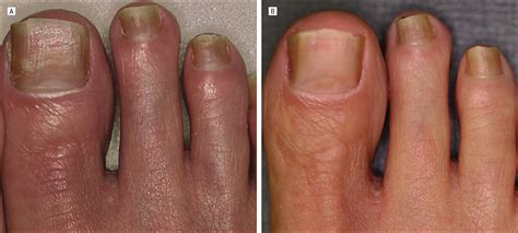 Successful Treatment of Toenail Onychomycosis With Photodynamic Therapy ...