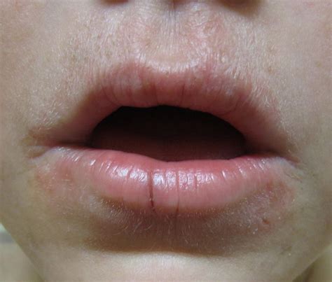 Actinic cheilitis facts | General center | SteadyHealth.com