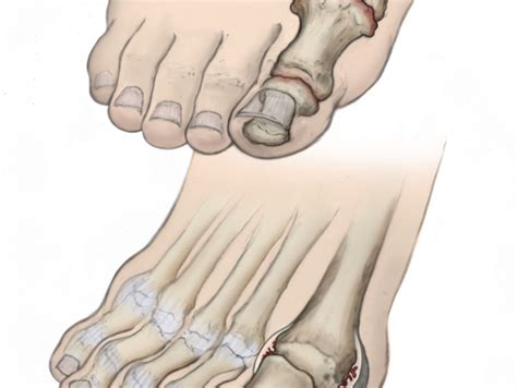 psoriatic arthritis feet Archives - DeNiel Foot and Ankle Center - Ejodamen B Shobowale, DPM