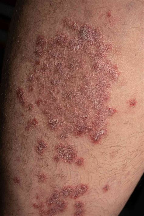 Guttate Psoriasis: Symptoms, Pictures, and Treatment