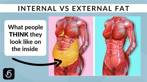 Understanding Internal vs External Fat and Liposuction [VISUAL GUIDE] - YouTube