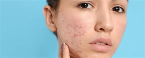 Why Does Acne Leave Red Marks | acne.com