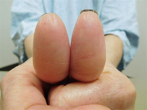 Cureus | Capecitabine-Associated Loss of Fingerprints: Report of Capecitabine-Induced ...