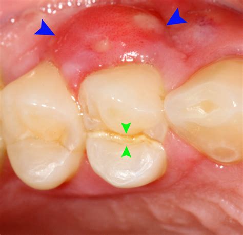 Abscessed tooth home remedy | General center | SteadyHealth.com