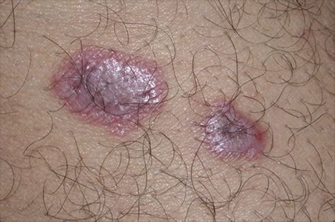 Dermatologic Skin Lesions