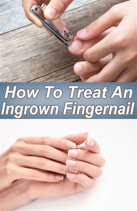 How To Treat An Ingrown Fingernail | Ingrown fingernail, Fingernails, Ingrown finger nail
