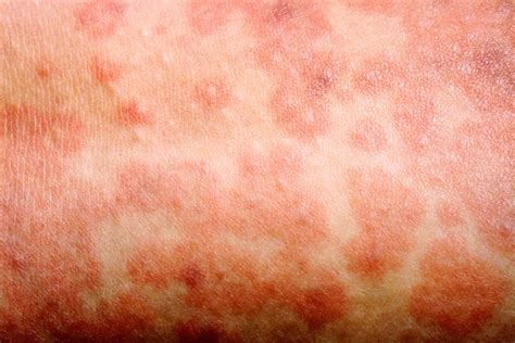 Measles - symptoms, causes and vaccination | healthdirect