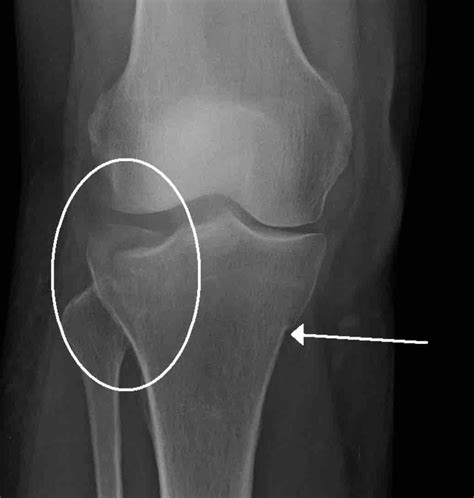 Stress Fracture X Ray Tibia