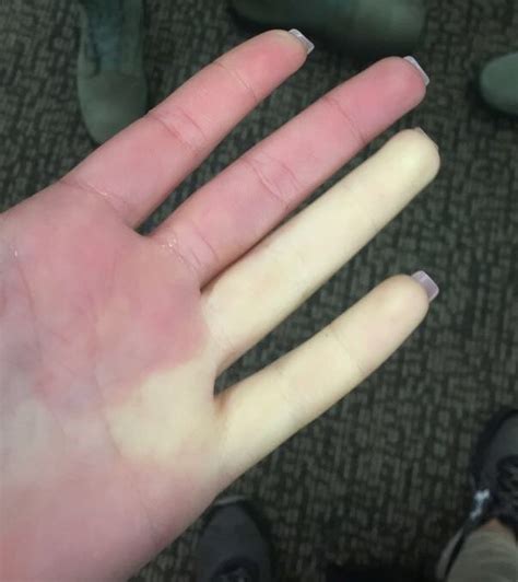 Sindromul Raynaud - Wikipedia