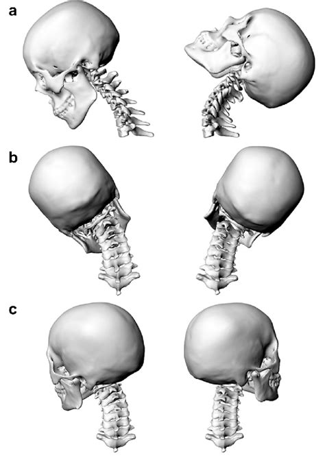 Registered 3D C0-T1 cervical spine models of a subject in different... | Download Scientific Diagram