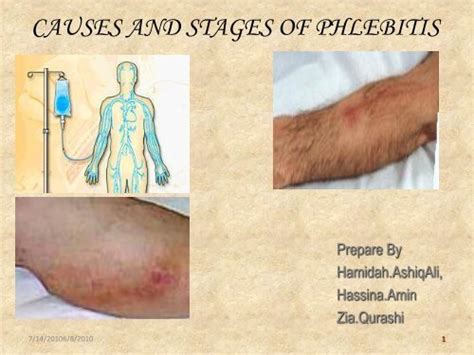 Iv Complications Phlebitis