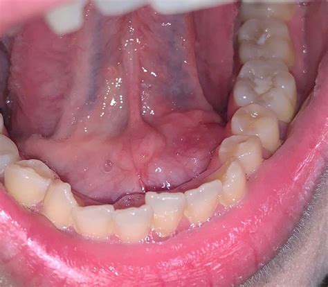 White Sores On Floor Of Mouth | Viewfloor.co