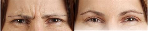 Botox Before and After Photos Jersey City NJ | Botox Jersey City NJ ...