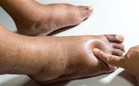 Causes of Foot and Ankle Swelling- Huntington Orthopedics